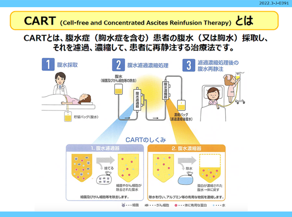 腹水濾過濃縮再静注法（CART）とは