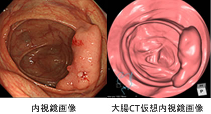 左：内視鏡画像　右：大腸CT仮想内視鏡画像