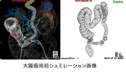 大腸癌術前シュミレーション画像